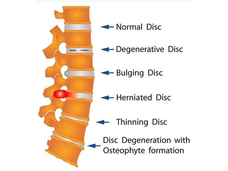 Spine crack. Stages of Disc Damage стадии повреждения диска 4 Erler - Zimmer.